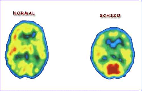 What Is Schizophrenia and cause of schizophrenia