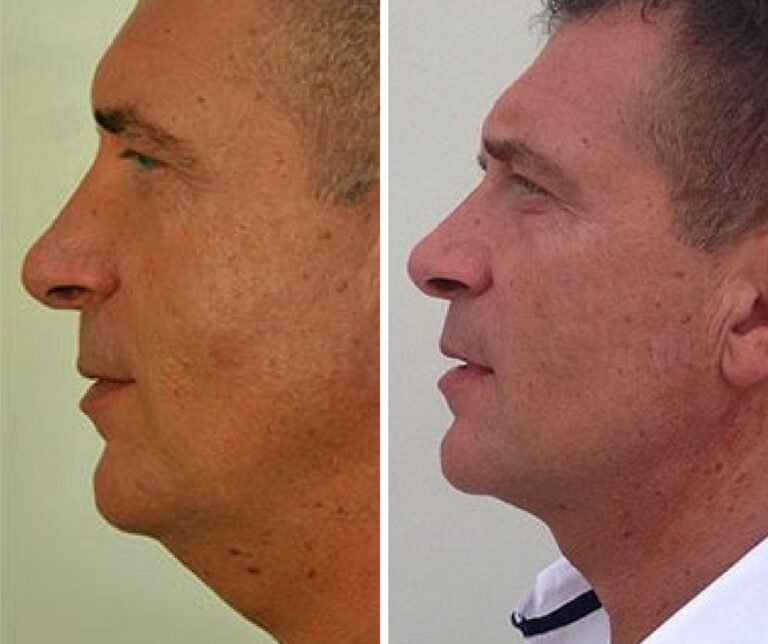 The Growing Popularity of Chin Liposuction Among Men